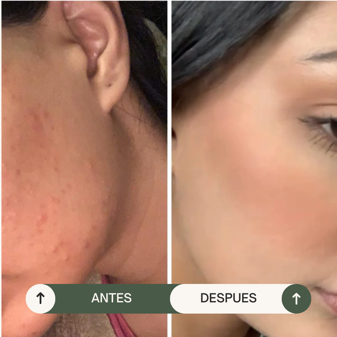 JABÓN ANTI-ACNÉ TEA TREE & JOJOBA