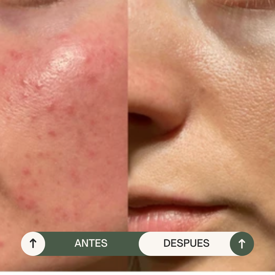 JABÓN ANTI-ACNE PIEL GRASA CARBÓN ACTIVADO